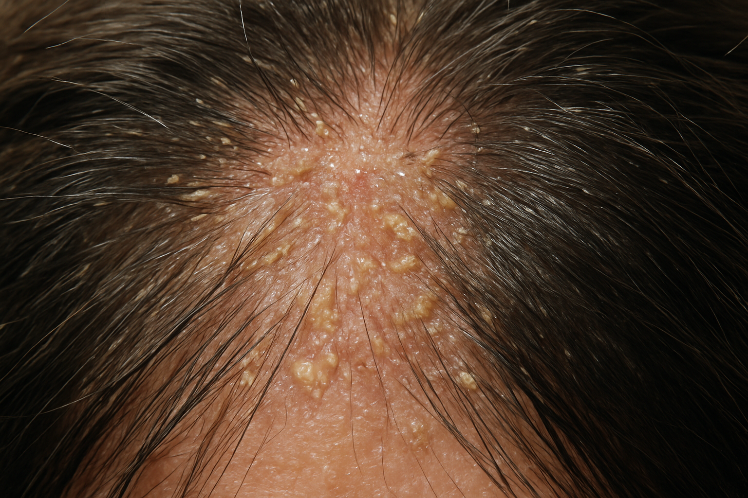 Create a realistic image of a close-up view of a human scalp showing buildup of product residue, excess oil, and dead skin cells accumulated around hair follicles, with visible flakes and greasy patches on the scalp surface, contrasted against healthy clean hair strands, shot with natural lighting that emphasizes the texture and condition differences, representing the need for scalp detoxing, absolutely NO text should be in the scene.