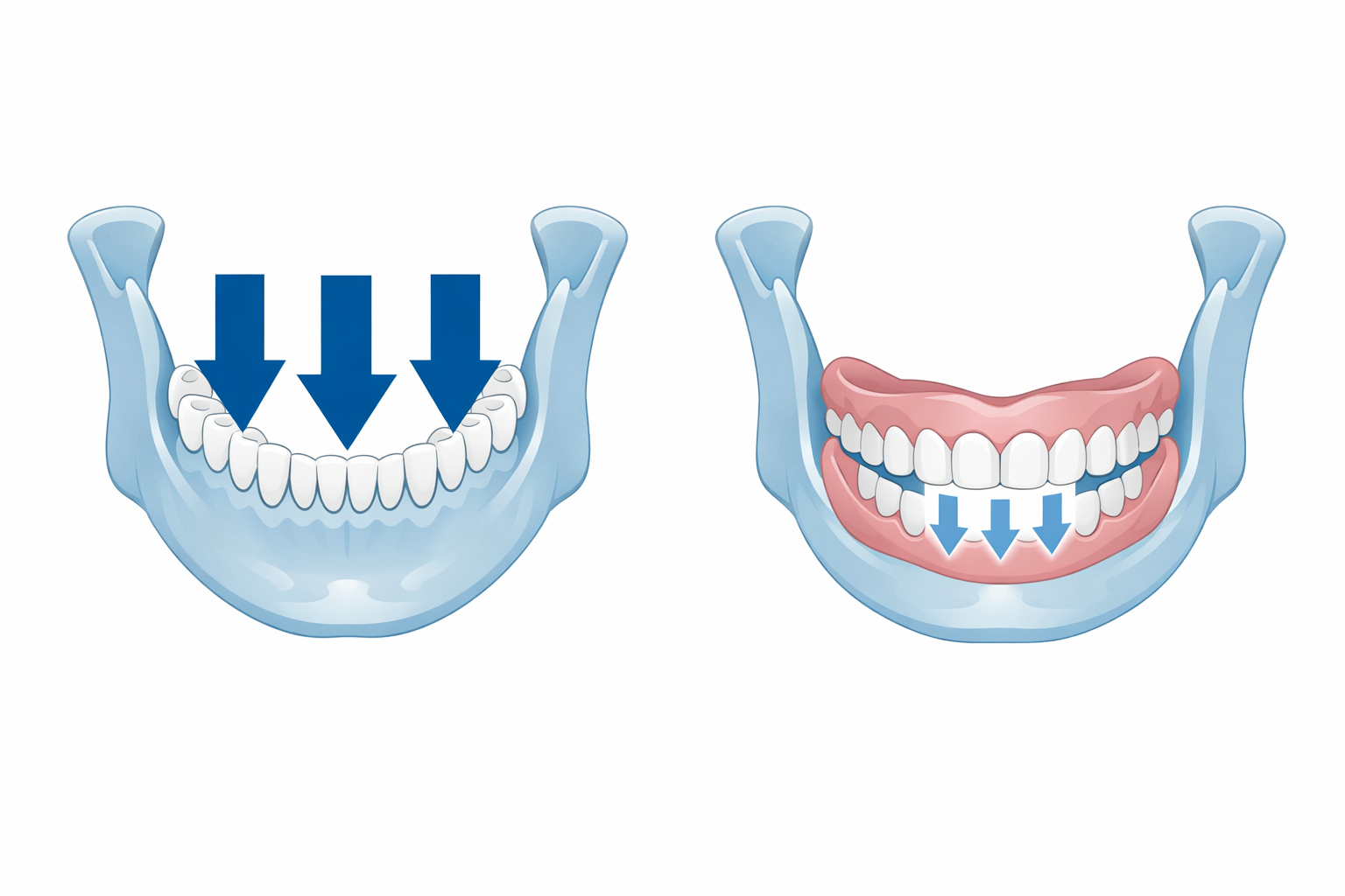 Denture VS Implant Denture VS Implant