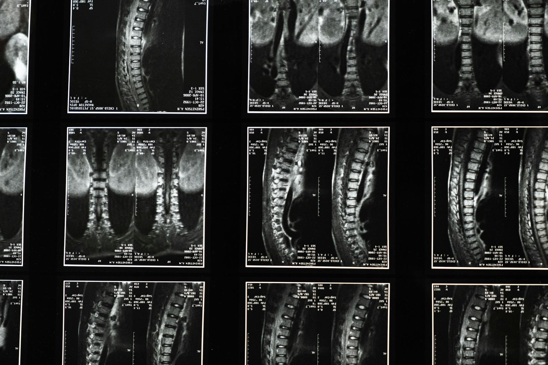 https://www.pexels.com/photo/medical-images-of-the-backbone-5723877/
